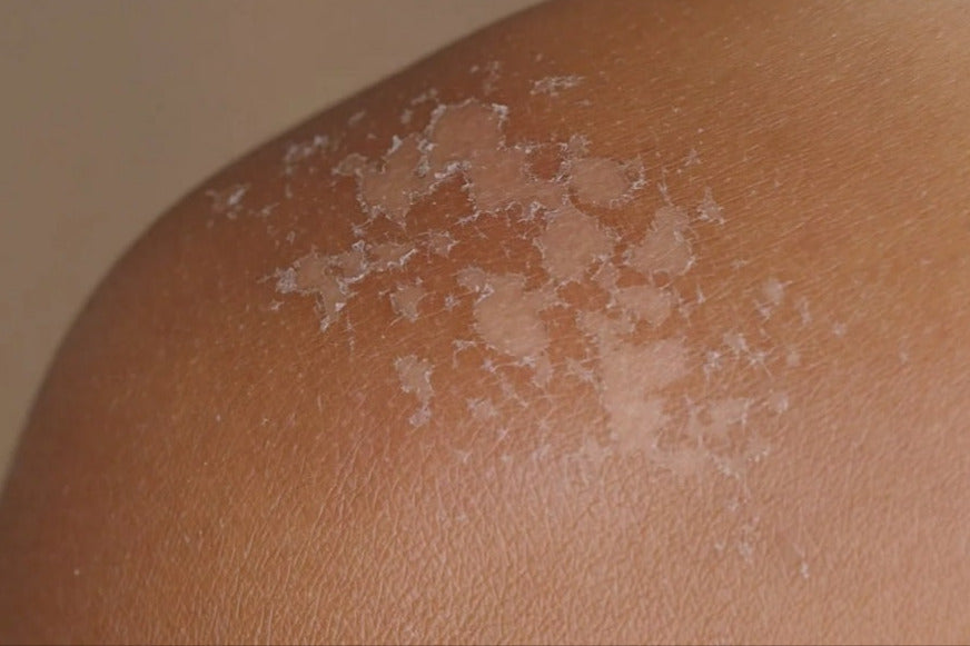 SkinPop